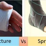 Fracture vs Sprain