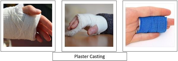 Plaster cast