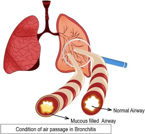 Air passage in bronchitis
