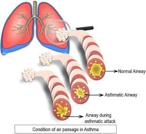 Difference Between Bronchitis and Asthma (with Comparison Chart) - Bio ...