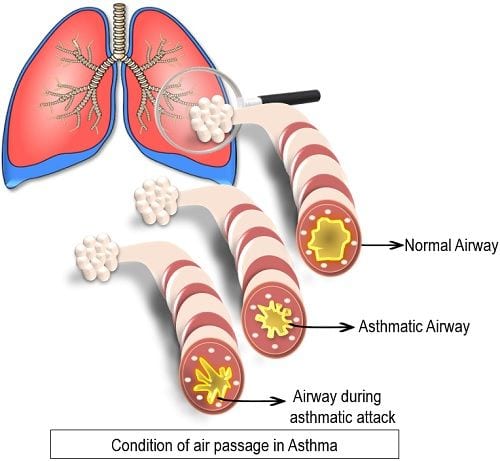 Air passage in asthma