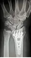 fracture difrnc