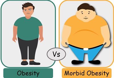 Obesity vs Morbid Obesity